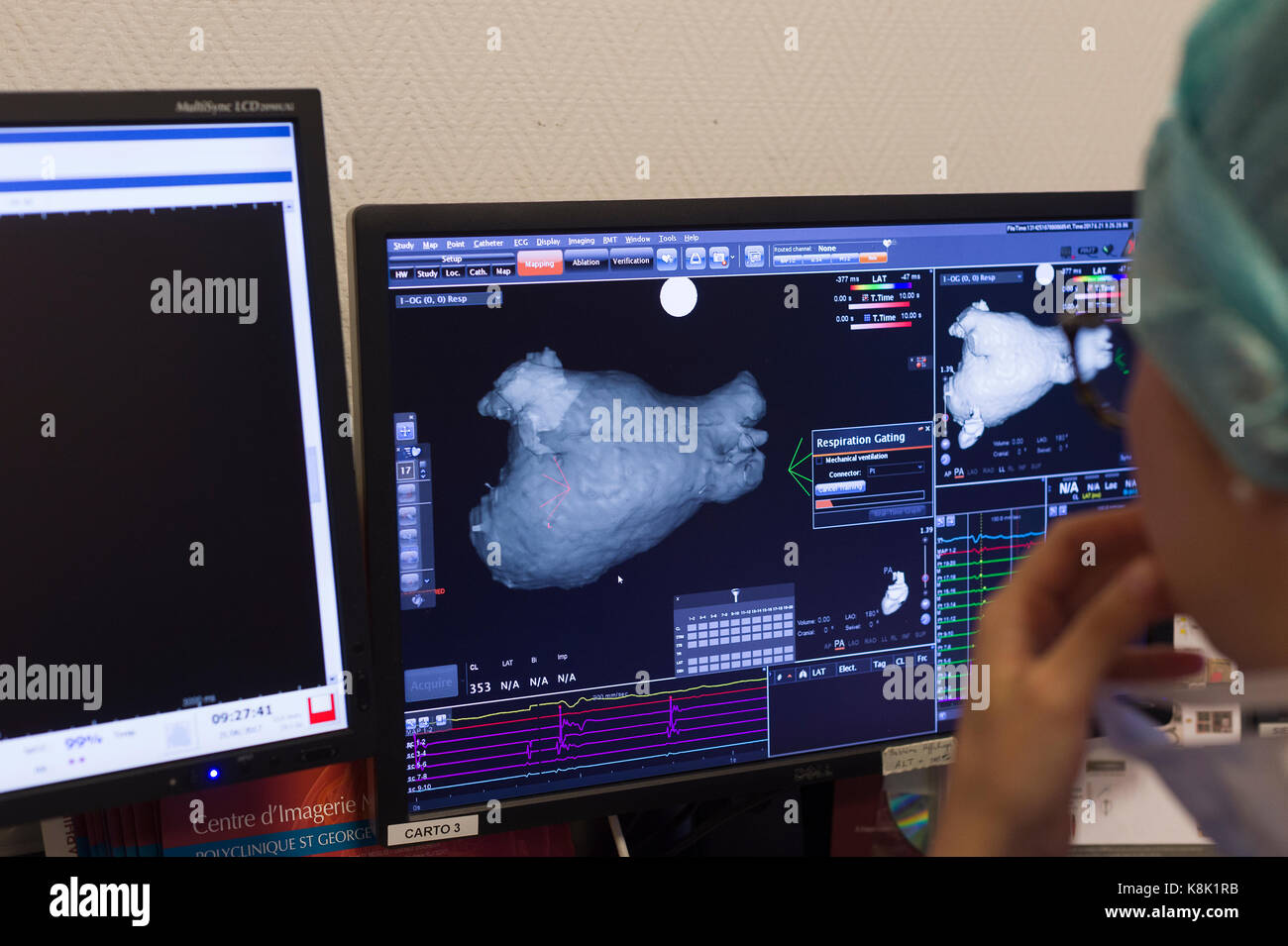 L'ablation par radiofréquence Banque D'Images