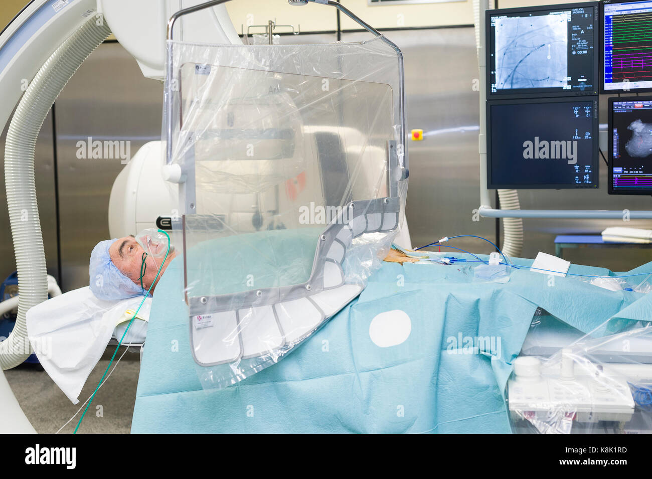 L'ablation par radiofréquence Banque D'Images