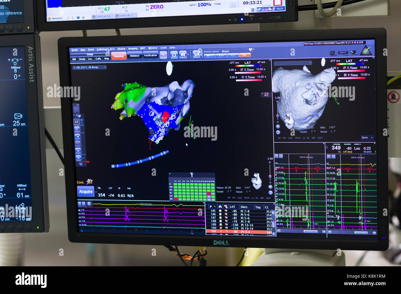 L'ablation par radiofréquence Banque D'Images