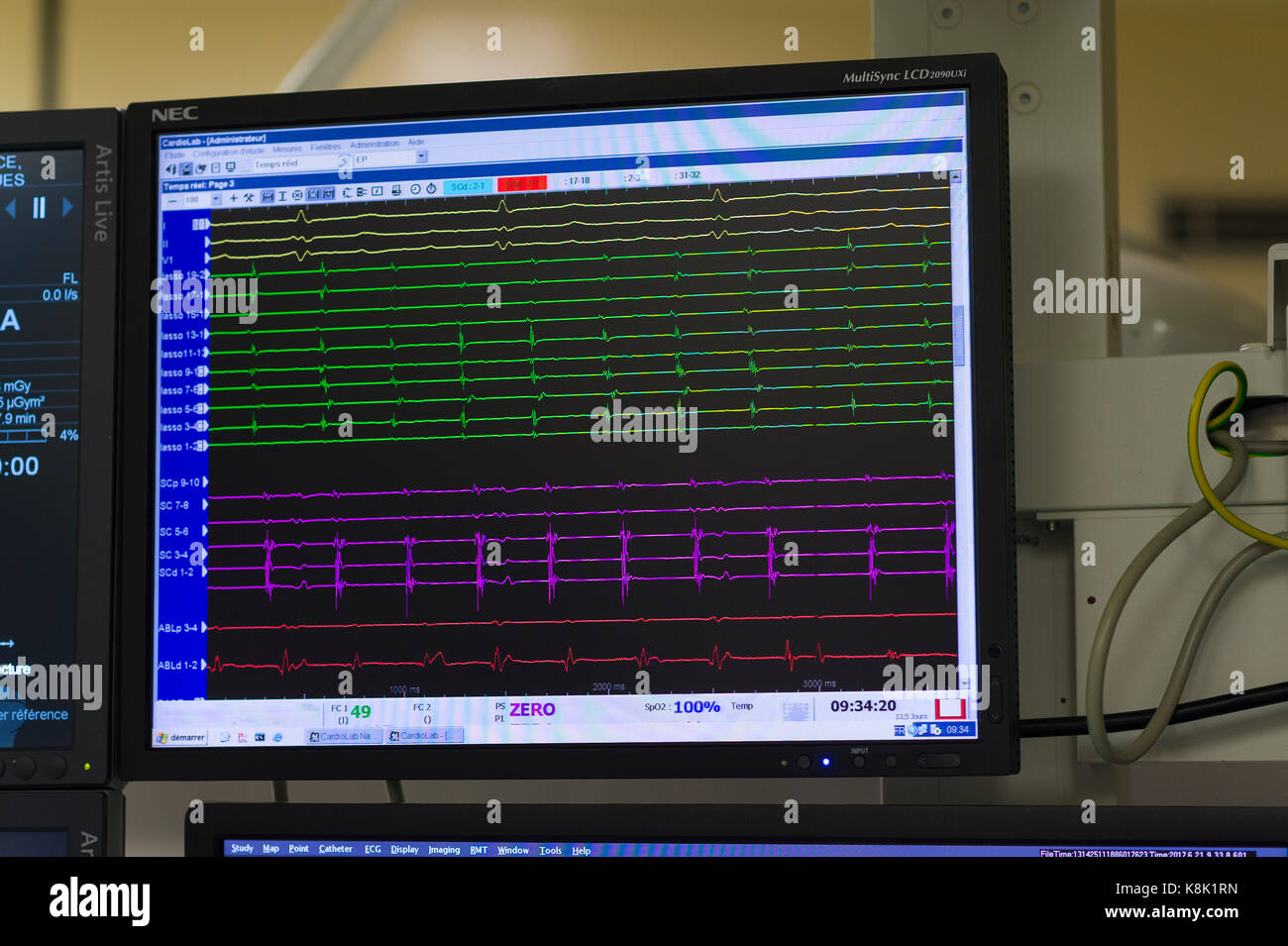 L'ablation par radiofréquence Banque D'Images