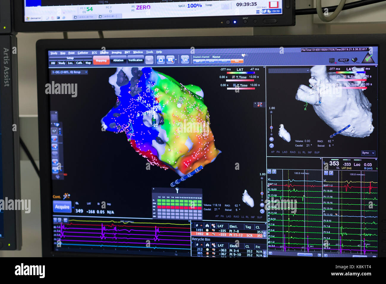 L'ablation par radiofréquence Banque D'Images