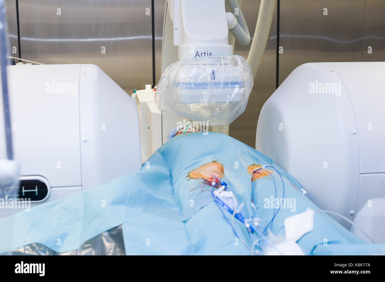 Radiofrequency ablation Banque de photographies et d’images à haute résolution Page 2 Alamy