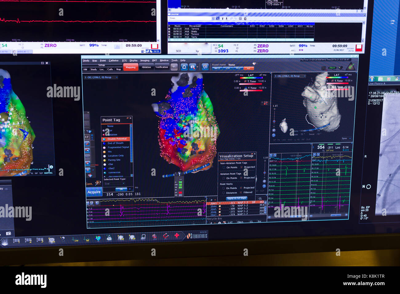 L'ablation par radiofréquence Banque D'Images