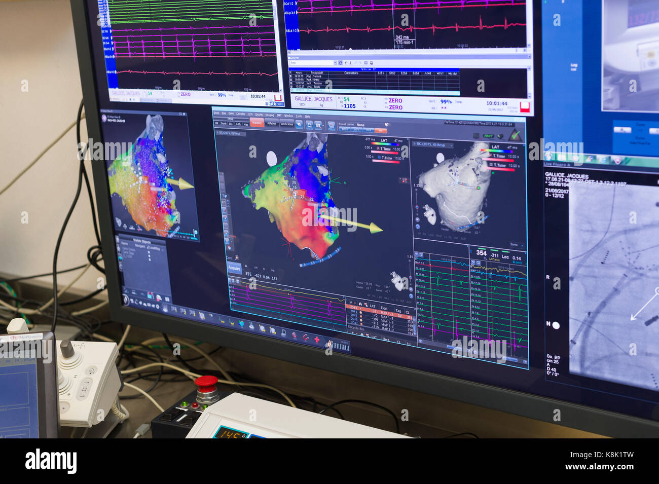 L'ablation par radiofréquence Banque D'Images