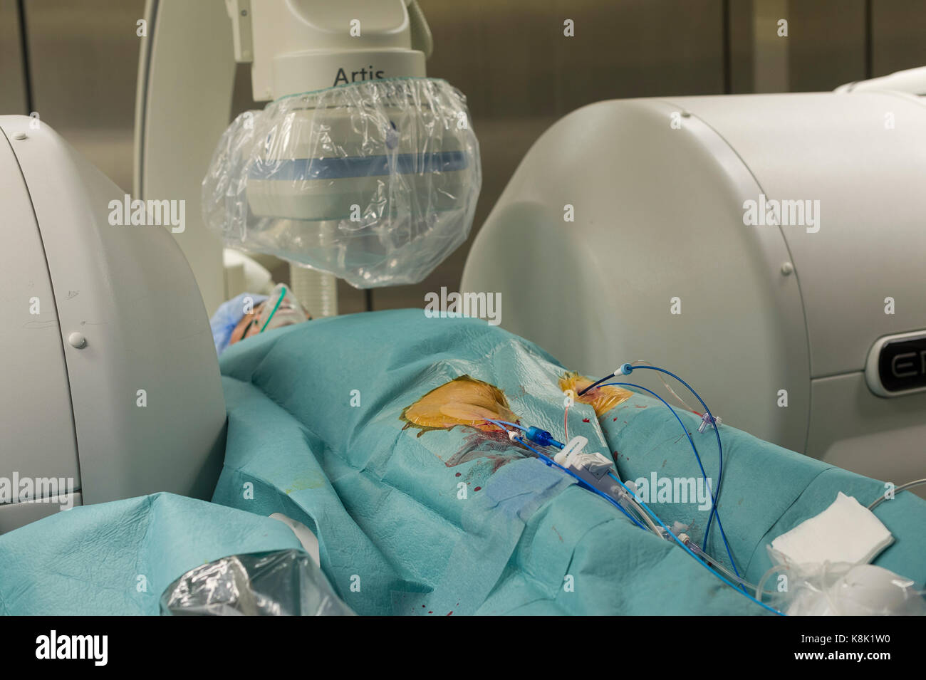 L'ablation par radiofréquence Banque D'Images