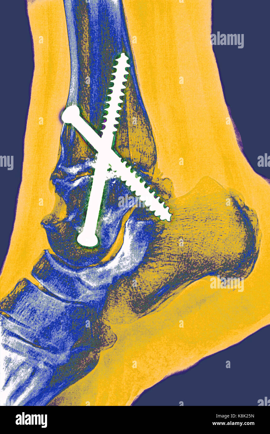 L'ostéosynthèse de la cheville, x-ray Photo Stock - Alamy