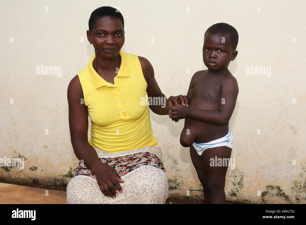Hernie Ombilicale Banque D Image Et Photos Alamy