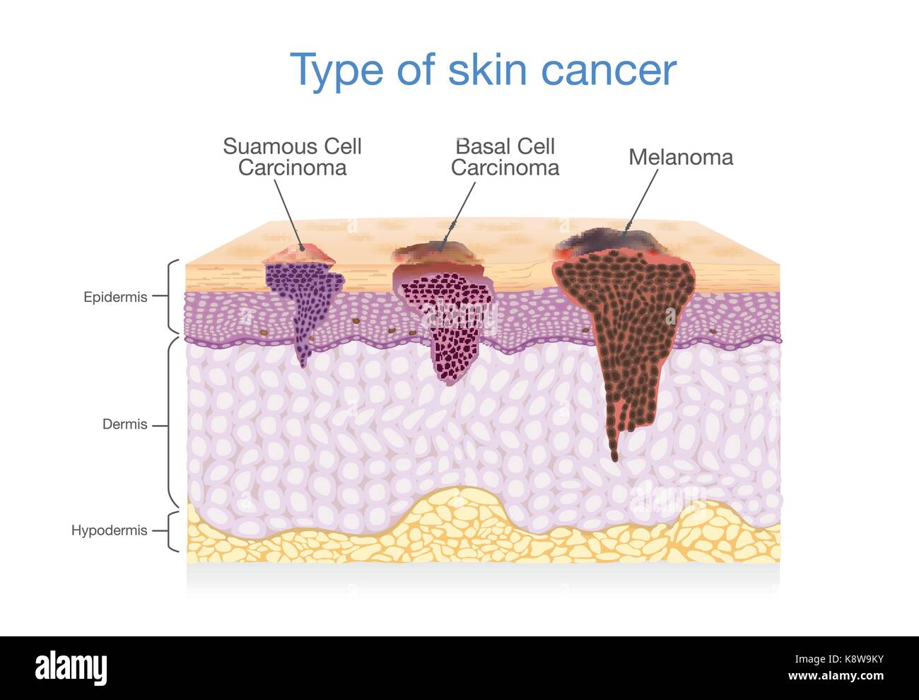 Couche de peau ont 3 type de cancer dans un. Illustration de Vecteur