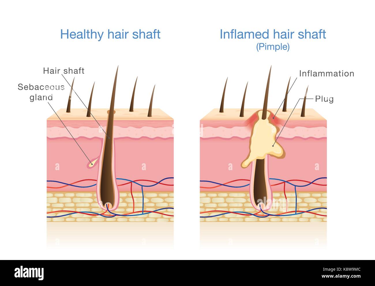 L'infection dans les follicules de cheveux. Illustration de Vecteur