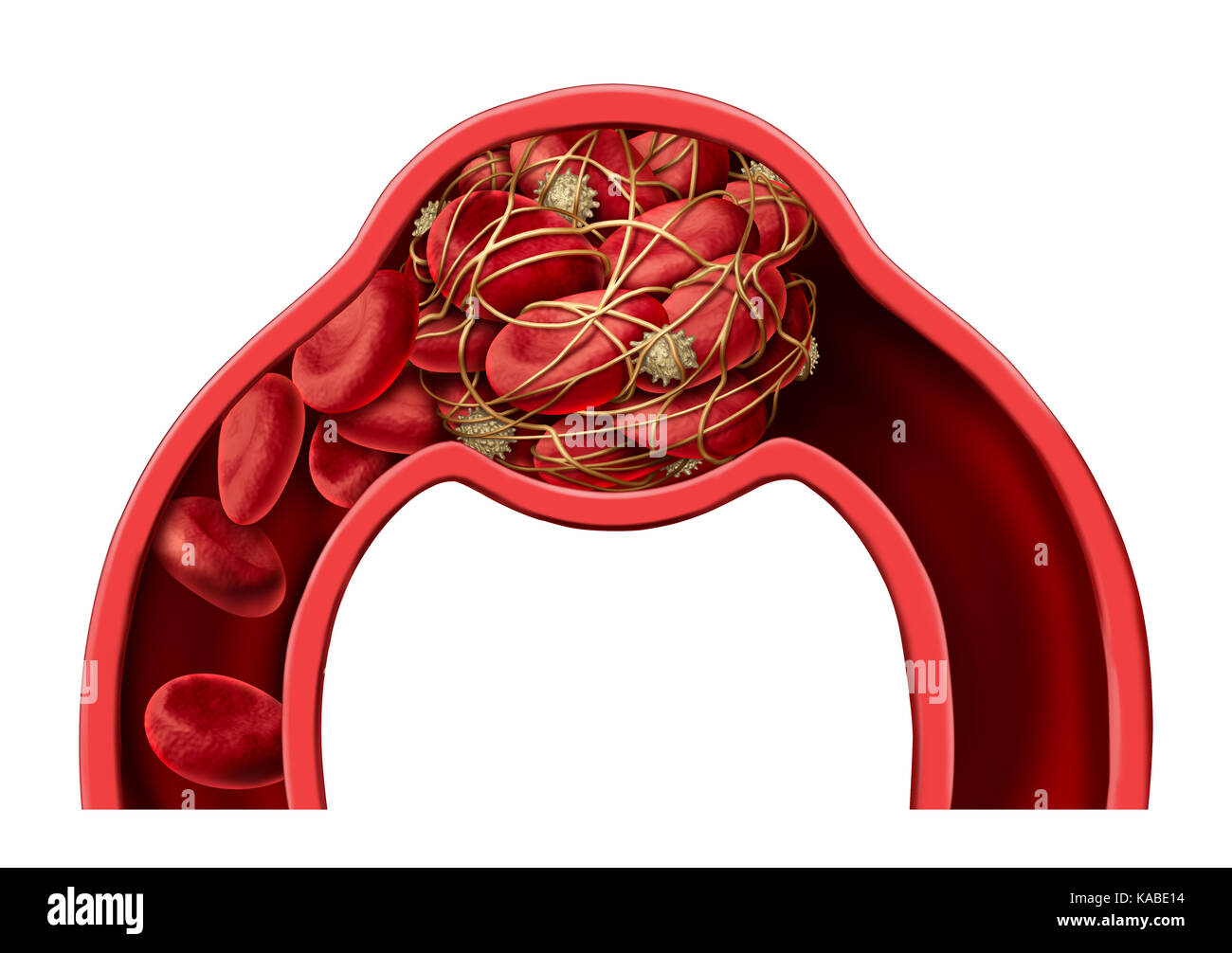 Caillot de sang symbole de la maladie et de thrombose medical 3d illustration concept comme un groupe de cellules sanguines humaines regroupés ensemble par des plaquettes collantes. Banque D'Images