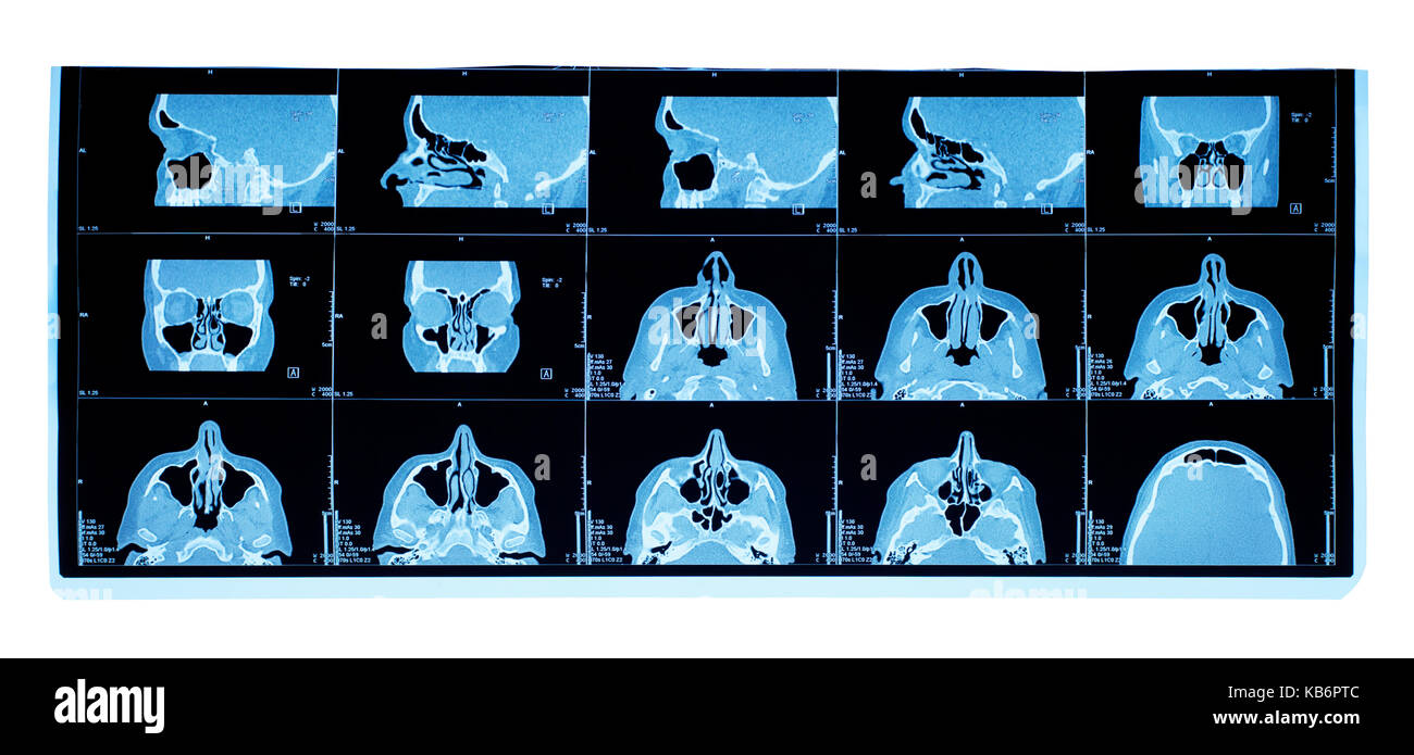 La tomographie assistée par ordinateur du sinus maxillaire déviation cloison nasale. Banque D'Images
