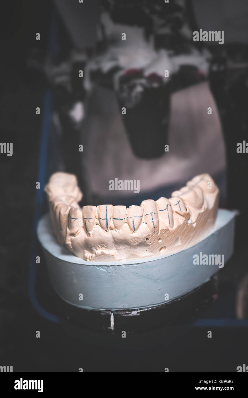 Prothèse dentaire, dent artificielle. photo de dents artificielles faites dans le laboratoire dentaire. Banque D'Images