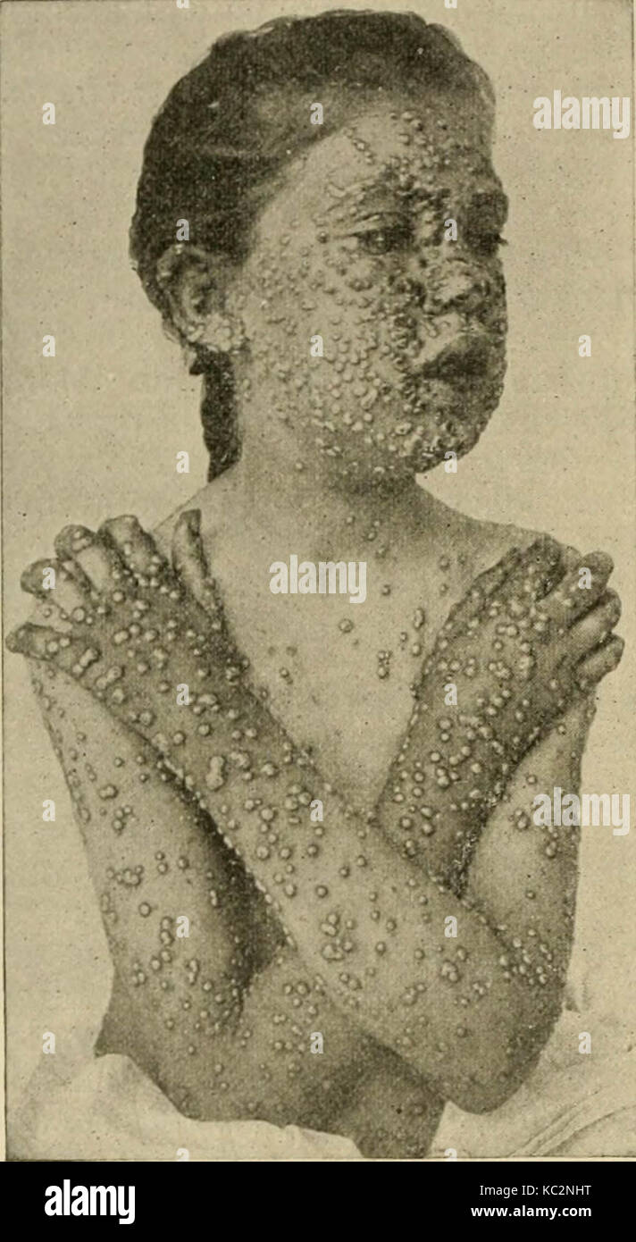 "Les maladies des nourrissons et des enfants (1919) Banque D'Images