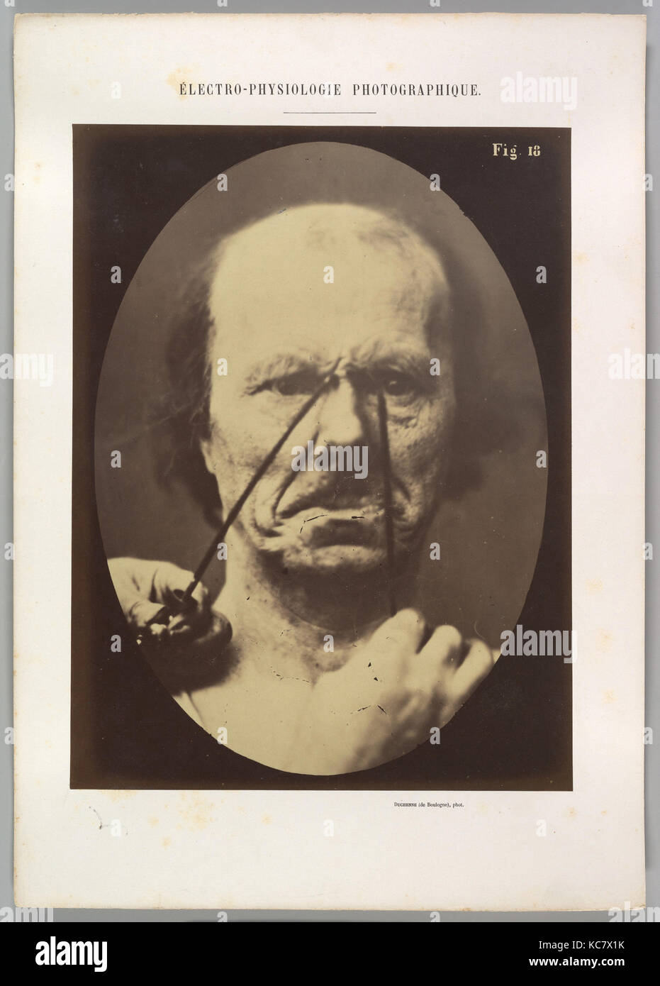 Figure 18 : agressivité, méchanceté, Guillaume-Benjamin Duchenne de Boulogne-Amand, 1854-56, 1862 imprimé Banque D'Images
