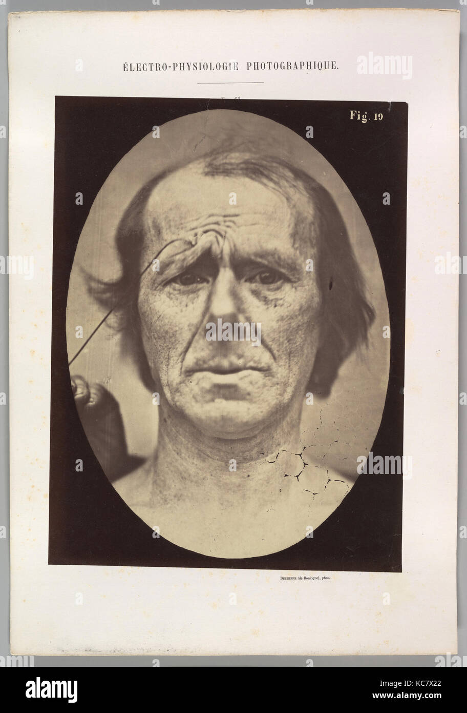 Figure 19 : la souffrance, Guillaume-Benjamin Duchenne de Boulogne-Amand, 1854-56, 1862 imprimé Banque D'Images