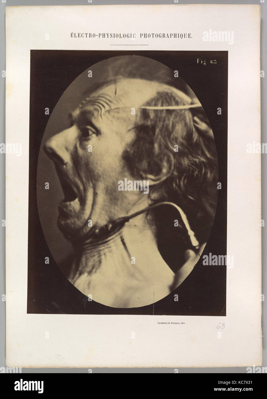 Figure 63 : Expression de terreur, Guillaume-Benjamin Duchenne de Boulogne-Amand, 1854-56, 1862 imprimé Banque D'Images