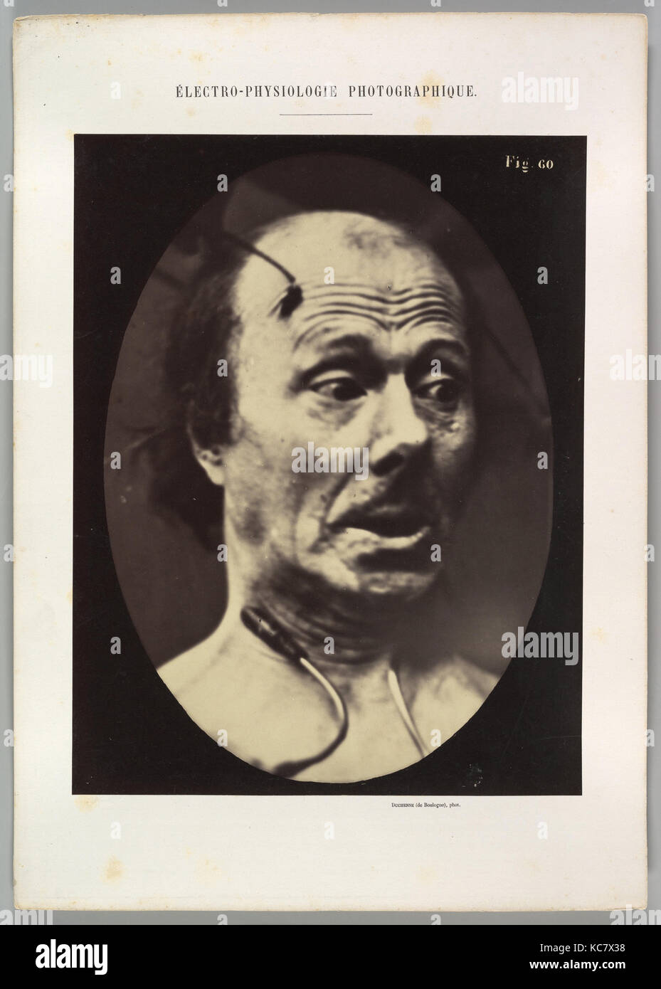 Figure 60 : Peur, Guillaume-Benjamin Duchenne de Boulogne-Amand, 1854-56, 1862 imprimé Banque D'Images