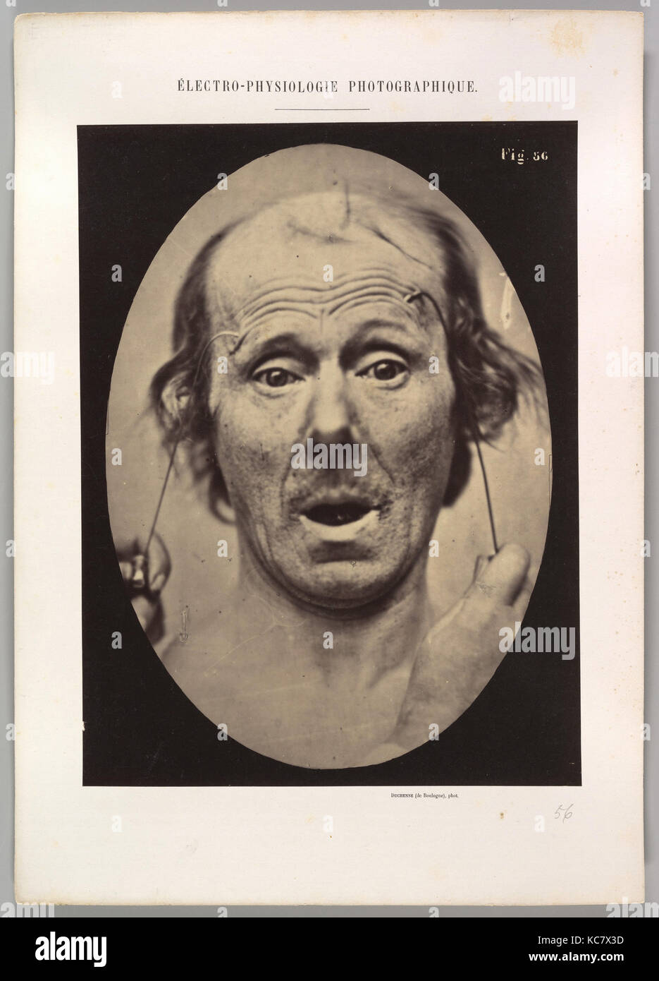 Figure 56 : Surprise, Guillaume-Benjamin Duchenne de Boulogne-Amand, 1854-56, 1862 imprimé Banque D'Images