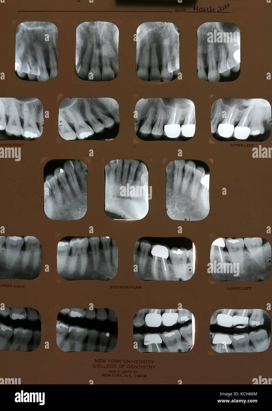 Les radiographies dentaires (la bouche pleine). Films montrent gommes de recul et de nombreux cours des canaux radiculaires avec des couronnes. Banque D'Images