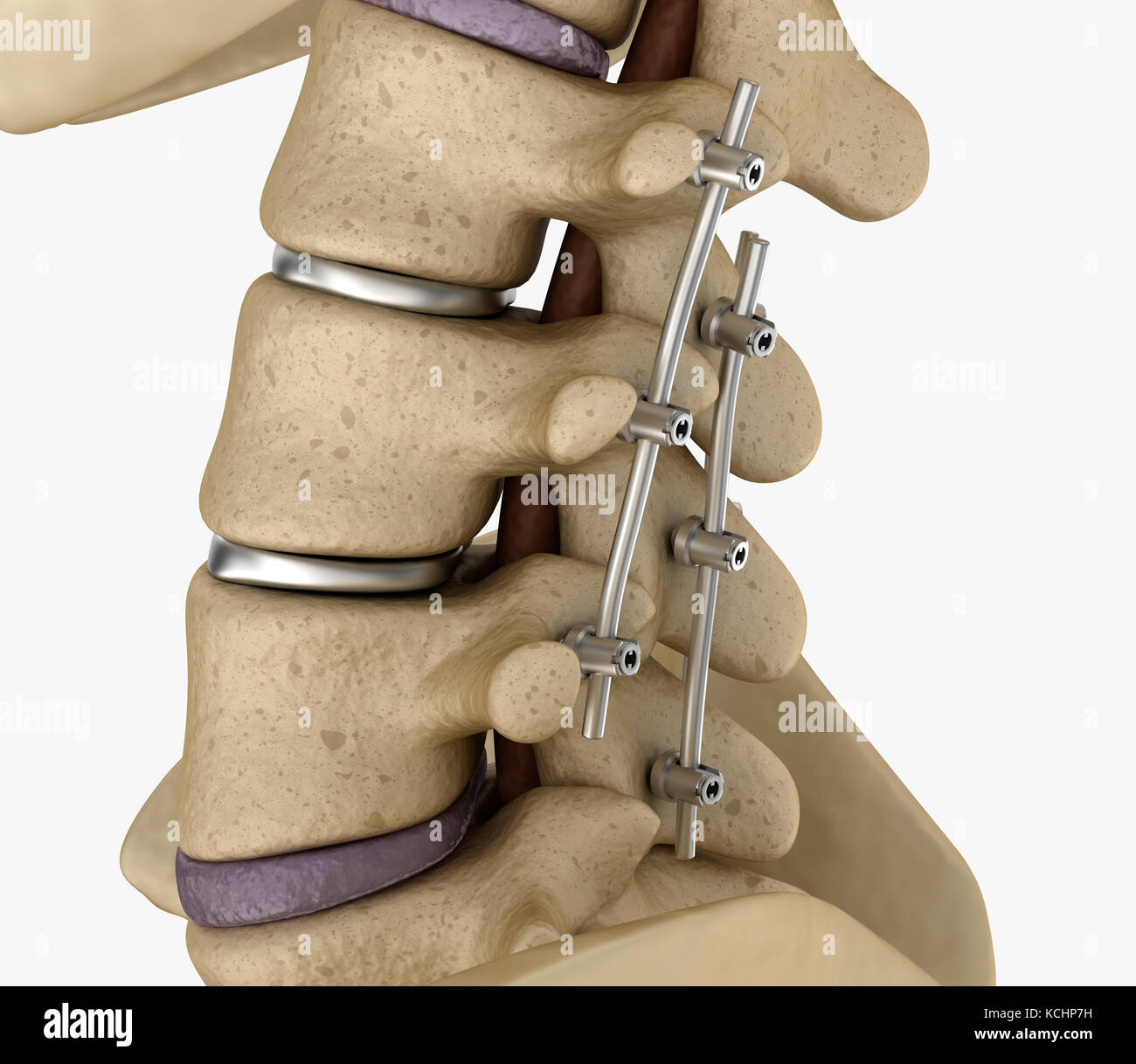 Système de fixation de la colonne vertébrale - titane support. Dent précise médicalement 3D illustration Banque D'Images