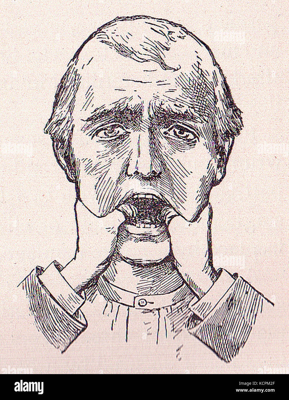 Mâchoire disloquée Banque D'Images