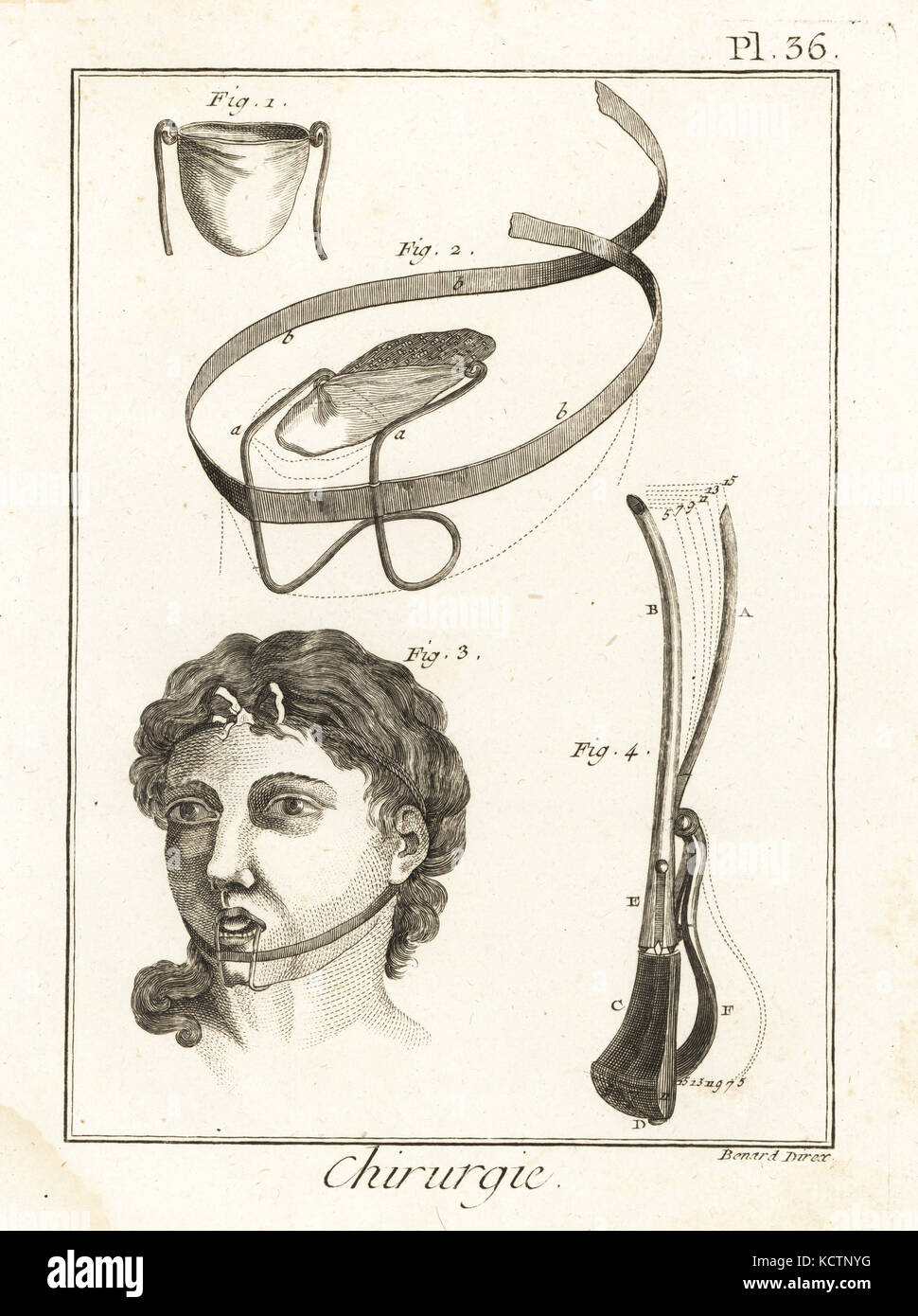 Médecin Pibrac's bandage pour une blessure de la langue la langue, 1,2 en place, 3 bandage et un lithotome, un instrument utilisé pour couper la vessie 4. La gravure sur cuivre par Robert Benard de Denis Diderot's Encyclopedia, Pellet, Genève, 1779. Banque D'Images