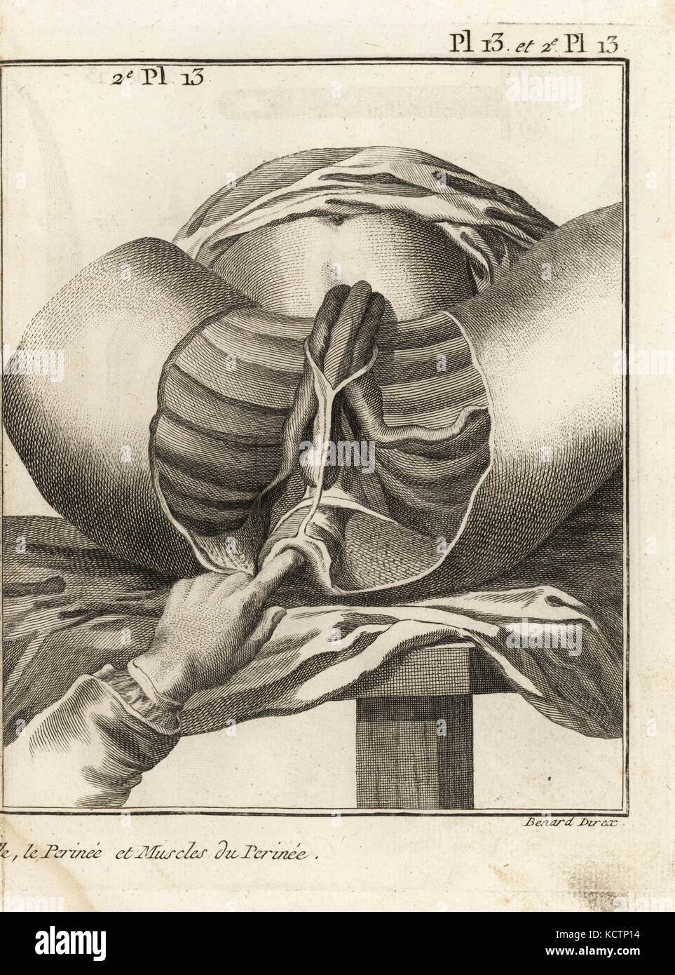 Foubert's intervention chirurgicale pour enlever une pierre de la vessie. Les muscles du périnée chez un sujet de 16 ou 17 ans. La gravure sur cuivre par Robert Benard de Denis Diderot's Encyclopedia, Pellet, Genève, 1779. Banque D'Images