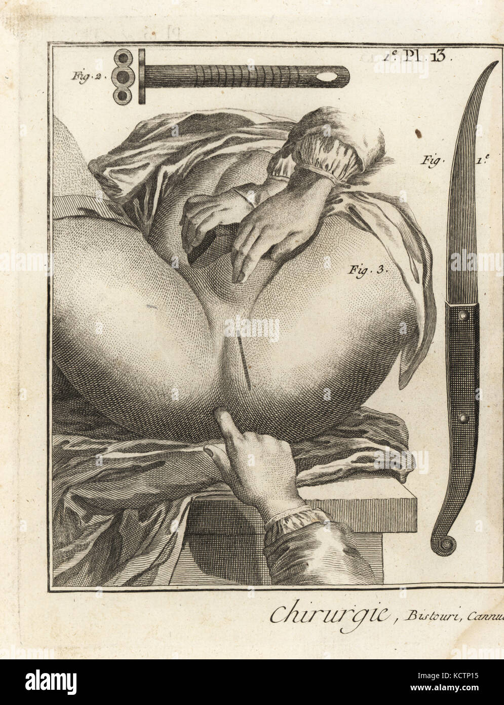 Foubert's intervention chirurgicale pour enlever une pierre de la vessie : M. Foubert's scalpel 1 canule souple, 2 et marquez sur le périnée pour l'incision externe. La gravure sur cuivre par Robert Benard de Denis Diderot's Encyclopedia, Pellet, Genève, 1779. Banque D'Images