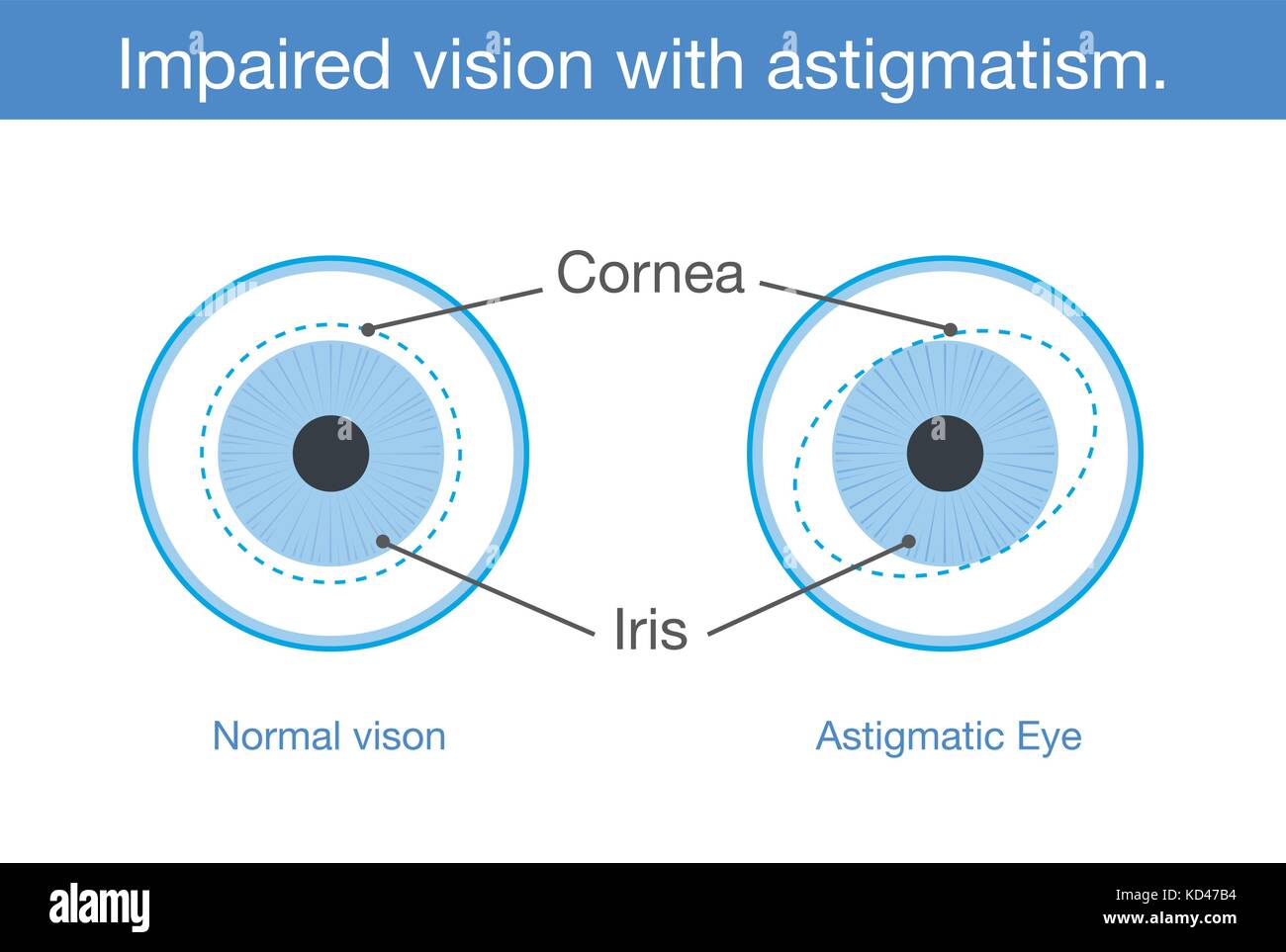 La vision normale et les troubles de la vision avec l'astigmatisme en vue de face. Illustration de Vecteur