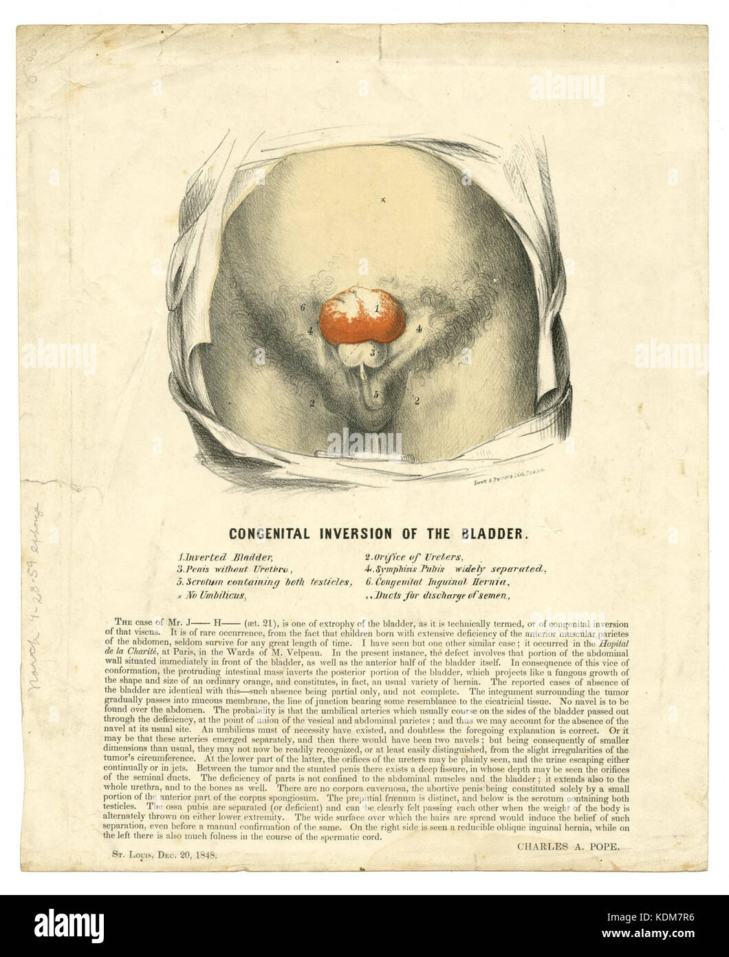 Poster médical illustré, imprimé, montrant les effets de l'Inversion congénitale de la vessie, le 20 décembre 1848 Banque D'Images