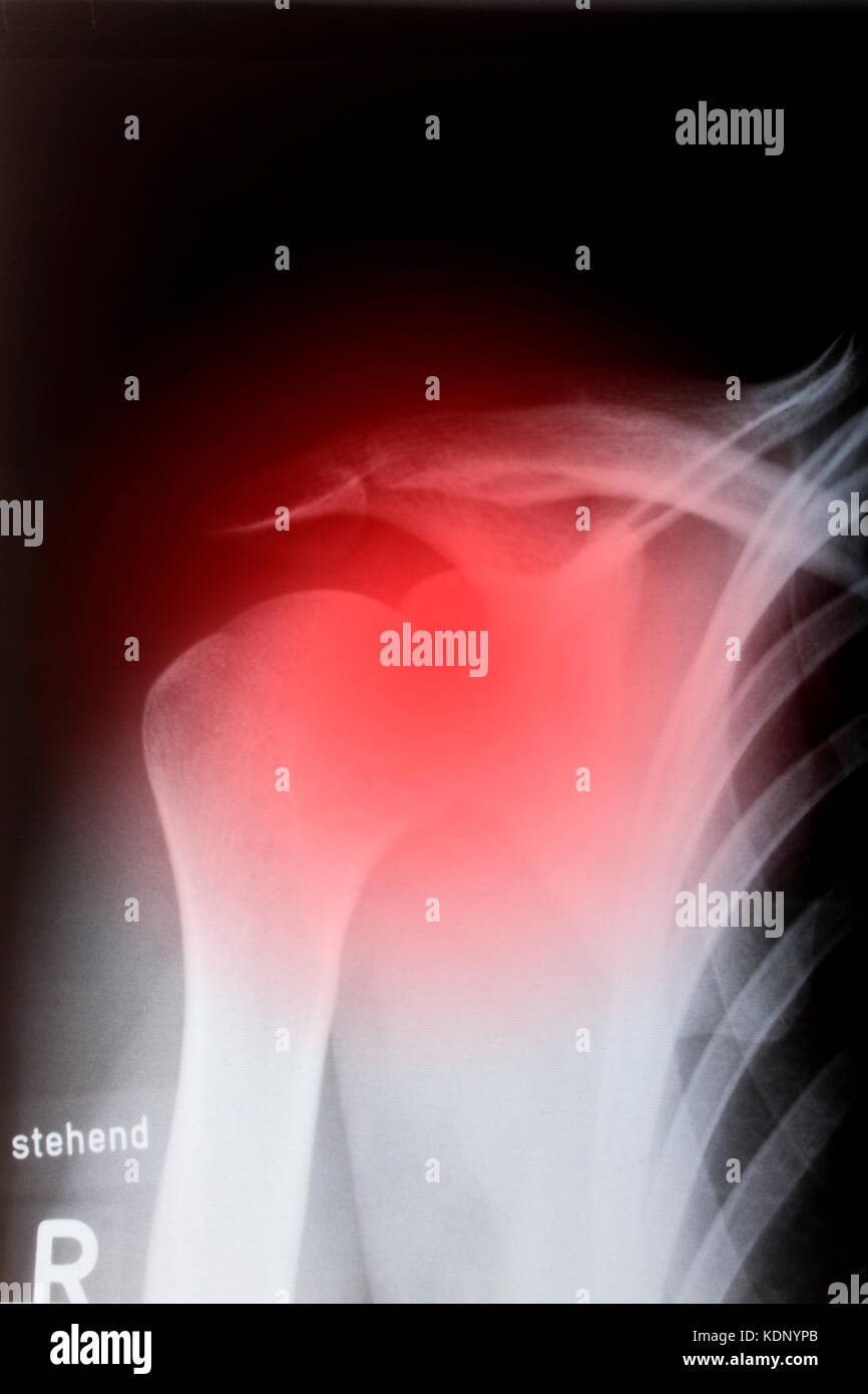 Les droits de l'épaule dans x-ray Banque D'Images