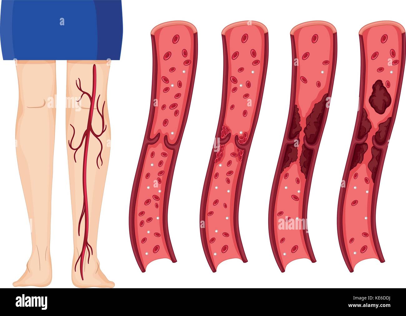 Caillot de sang dans les jambes de l'illustration (thombosis) Illustration de Vecteur