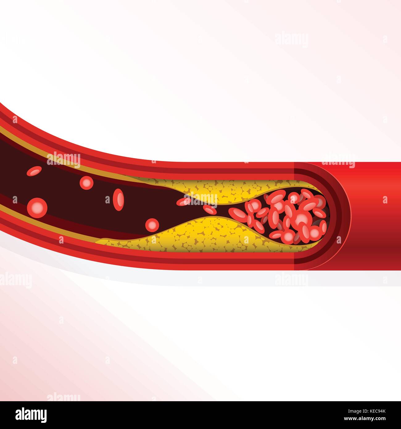 La thrombose de l'artère de l'accumulation de cholestérol, l'artériosclérose - Illustration de Vecteur