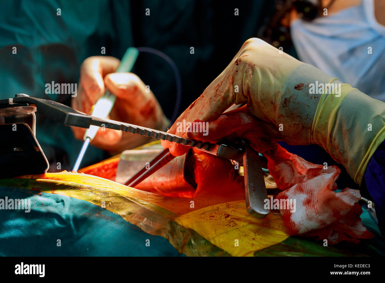 Greffe du foie en salle d'opération, la chirurgie à l'hôpital sur le coeur ouvert poitrine en chirurgie cardiaque Banque D'Images Greffe du foie en salle d'opération, la chirurgie à l'hôpital sur le coeur ouvert poitrine en chirurgie cardiaque Banque D'Images
