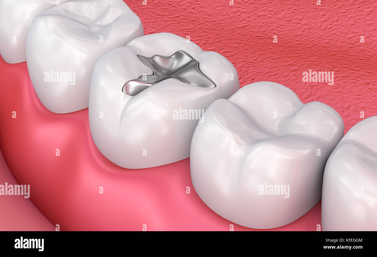 Metall obturations dentaires médicalement exacts, 3D illustration Banque D'Images