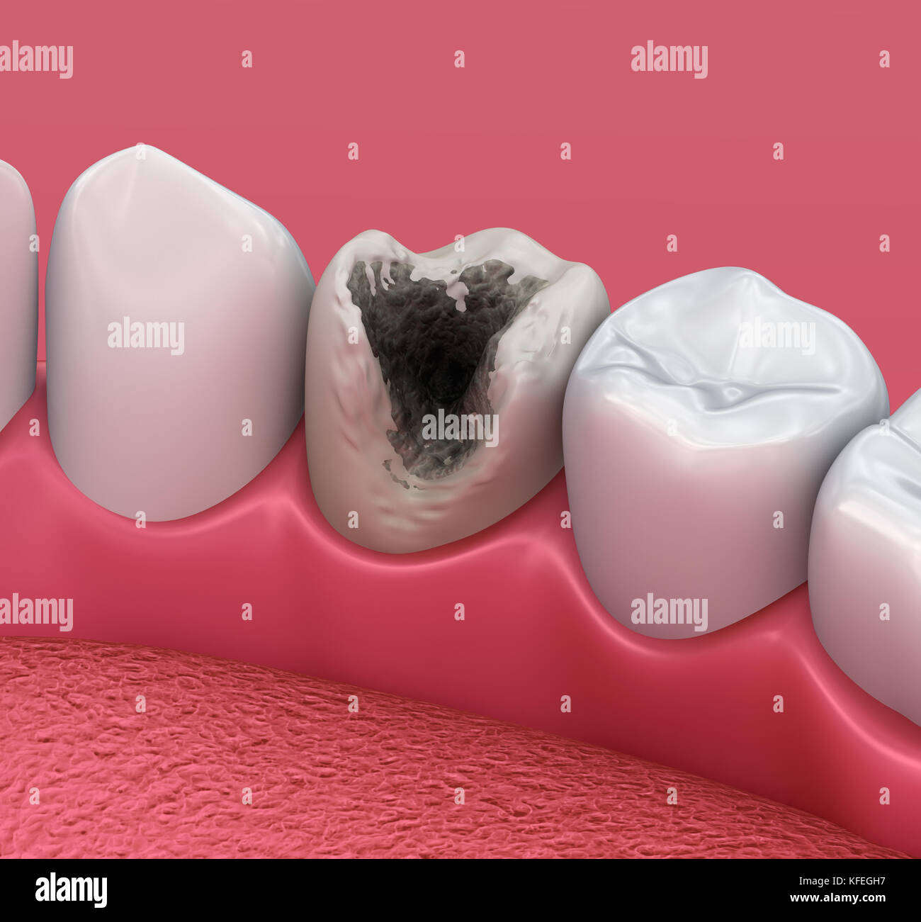Dents caries, traitement. Illustration 3D des dents médicalement précises Banque D'Images
