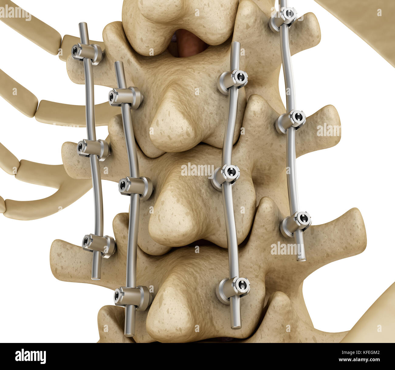 Système de fixation de la colonne vertébrale - titane support. Dent précise médicalement 3D illustration Banque D'Images