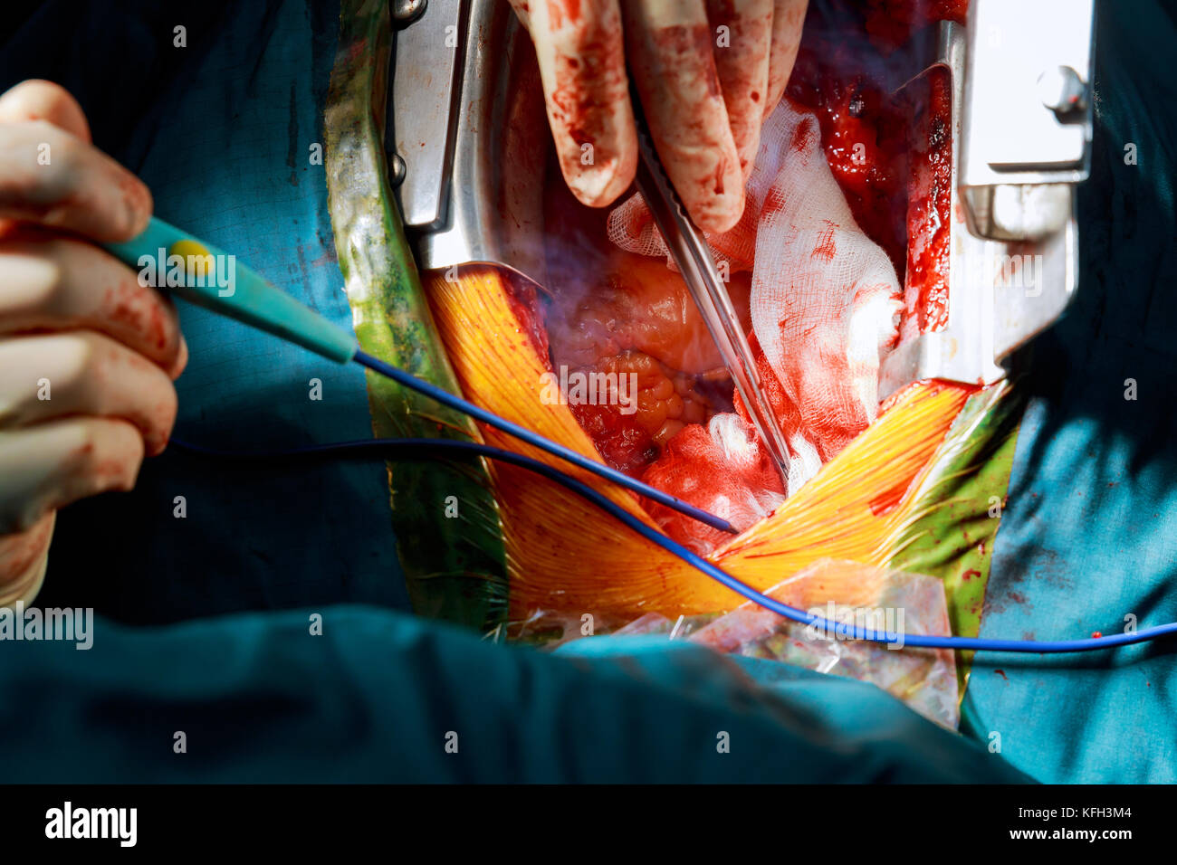 La méthode chirurgicale minimalement invasive avec une petite incision pour une chirurgie pour enlever transcatheter aortic valve implantation extensible rem Banque D'Images