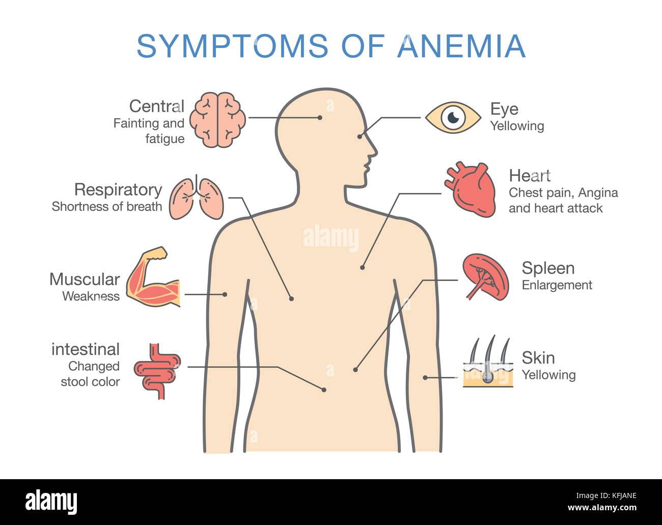 Les symptômes communs à de nombreux types d'anémie. Illustration de Vecteur