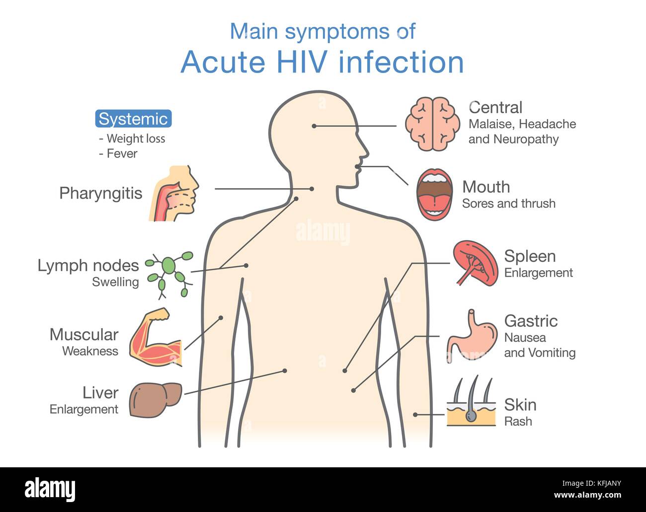 Principal symptôme de l'infection aiguë par le VIH. Illustration de Vecteur
