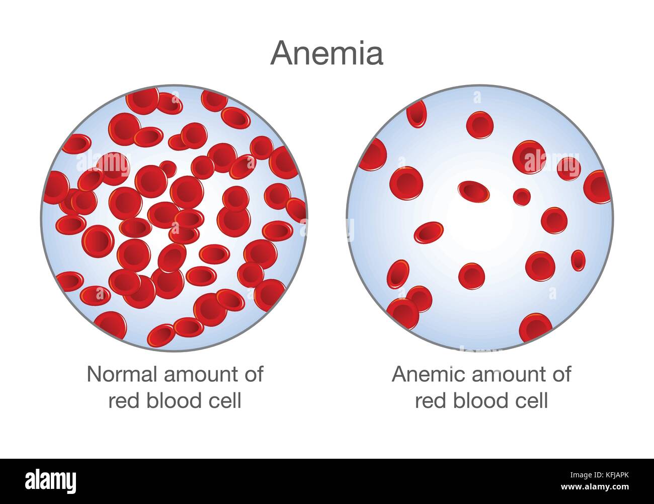 La différence de montant de l'anémie et de globules rouges normaux. Illustration de Vecteur