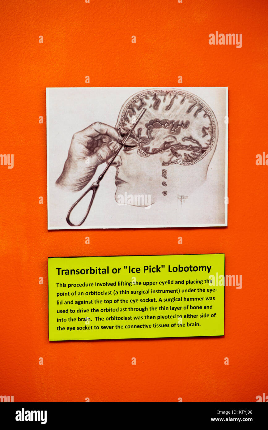 Saint-Joseph, Missouri. Musée Psychiatrique De Glore. Affichage montrant la lobotomie de sélection de glace. Banque D'Images