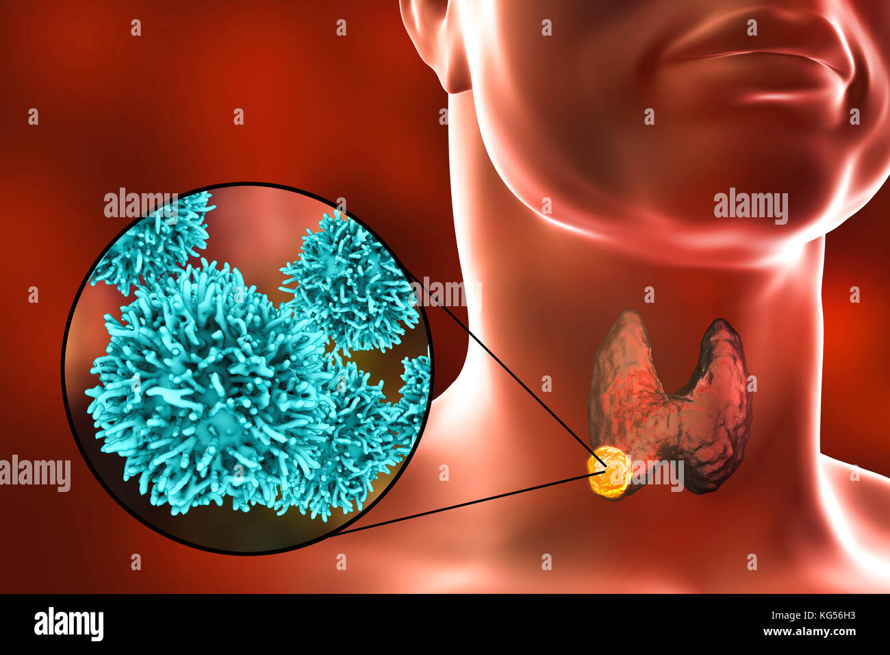 Les droits de l'glande thyroïde montrant une tumeur et vue rapprochée de cellules de cancer de la thyroïde, l'illustration de l'ordinateur. Banque D'Images