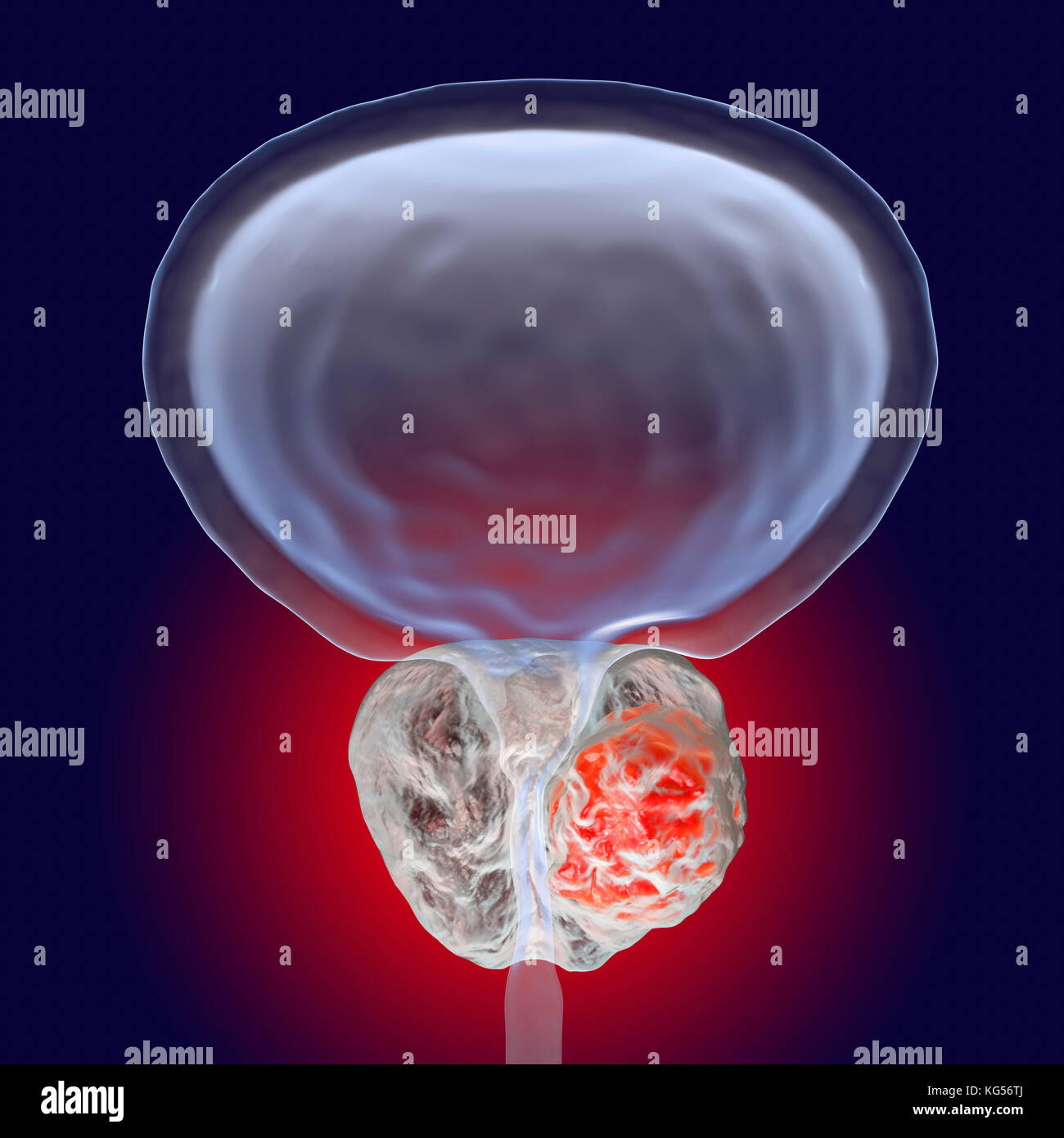 Le cancer de la prostate. Illustration d'ordinateur d'une tumeur cancéreuse (centre droit) dans la glande de prostate (blanc, centre). L'urètre peut être vu du centre de la prostate, de la vessie (en haut). Le cancer de la prostate est un des cancers les plus courants, de sexe masculin qui affecte généralement les personnes âgées. La croissance d'une tumeur de la prostate peuvent bloquer le col de la vessie, porter atteinte à la miction. Cependant, c'est un cancer à croissance lente. S'il est diagnostiqué, le traitement implique la chirurgie pour enlever la prostate, ou la radiothérapie. Banque D'Images