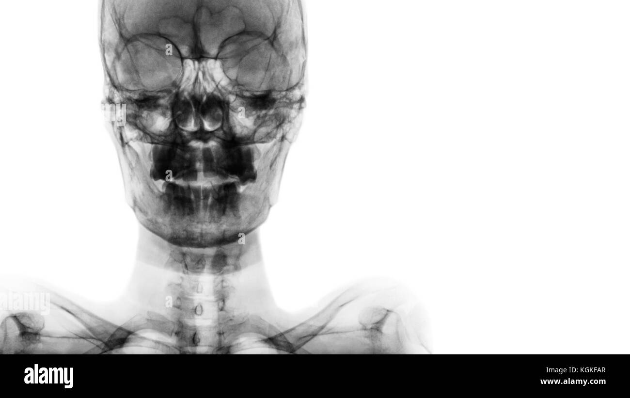 Film x-ray crâne ap : montrer le crâne humain normal et la zone vide du côté droit . Banque D'Images