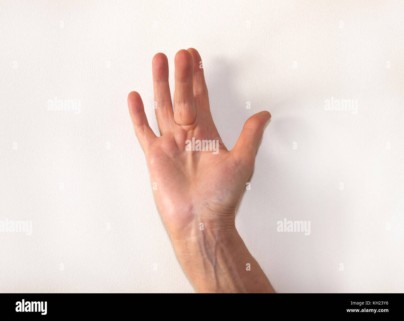 La maladie de Dupuytren difformité : une corde dans la paume de la main (avec un disque dur à la base des nodules le doigt du milieu), tire sur le doigt dans une position courbée. Banque D'Images