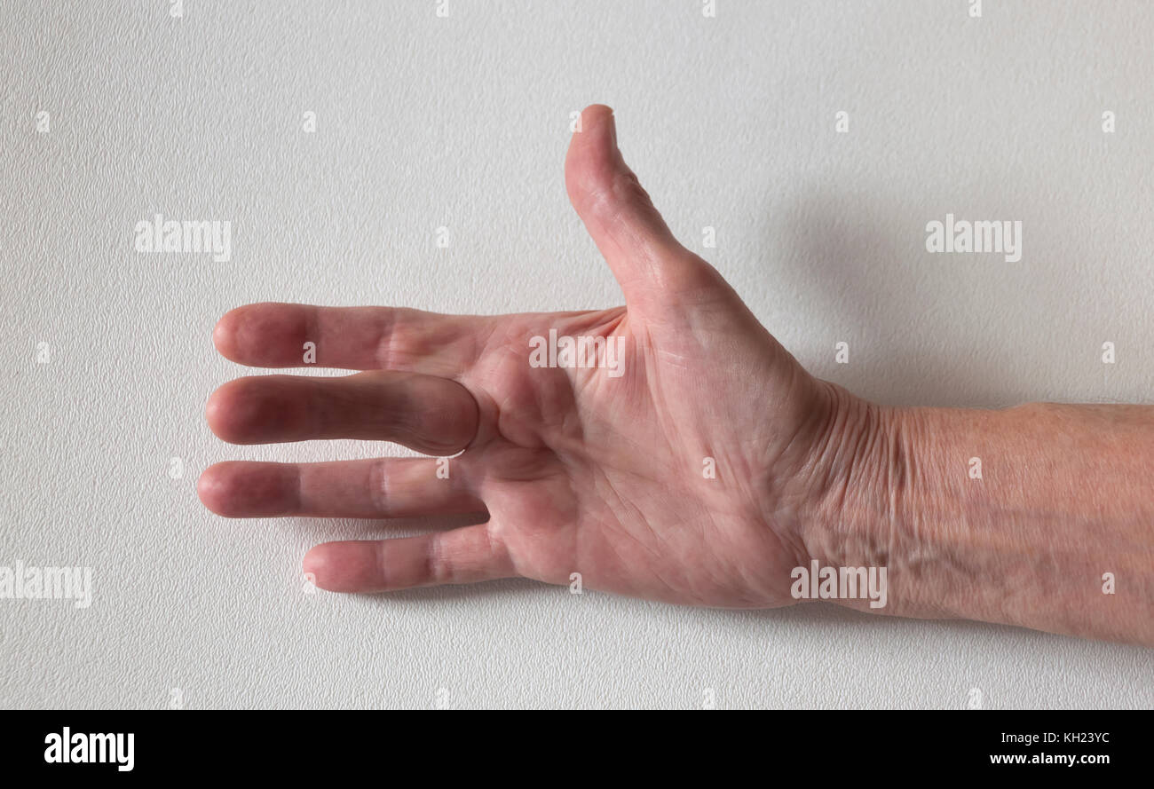 La maladie de Dupuytren difformité : une corde dans la paume de la main (avec un disque dur à la base des nodules le doigt du milieu), tire sur le doigt dans une position courbée. Banque D'Images