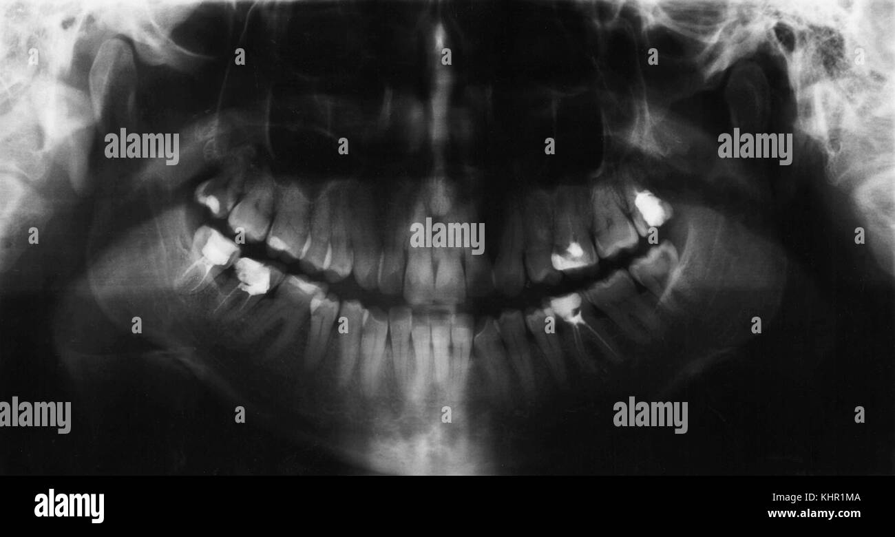 X-ray image panoramique des dents Banque D'Images