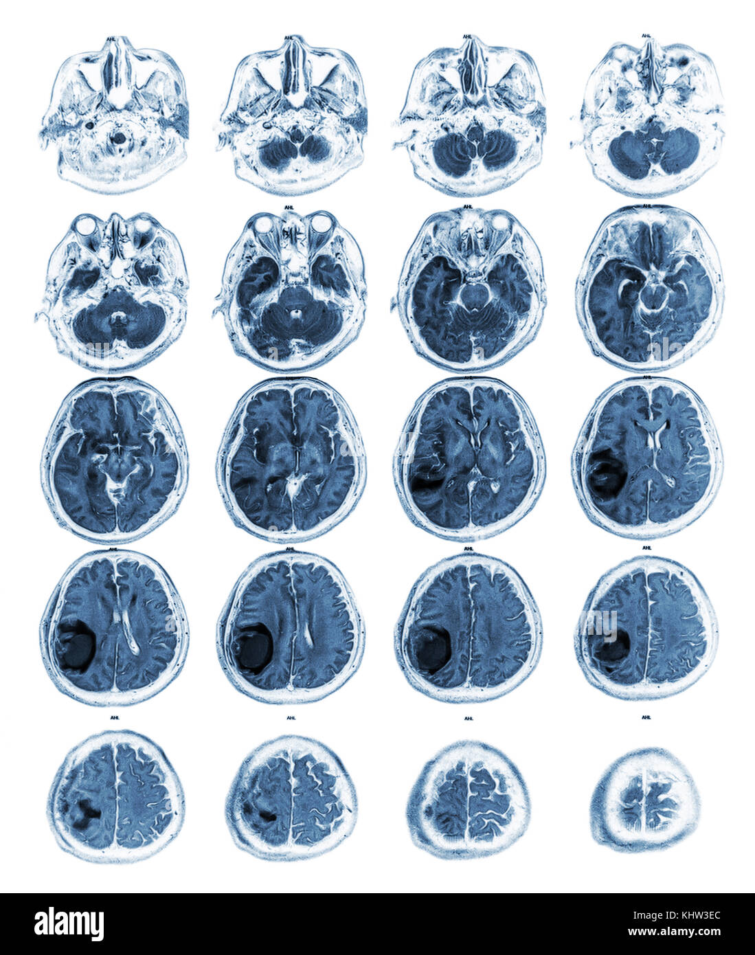 Voir irm de cerveau Tumeur au cerveau droit au lobe pariétal . Banque D'Images