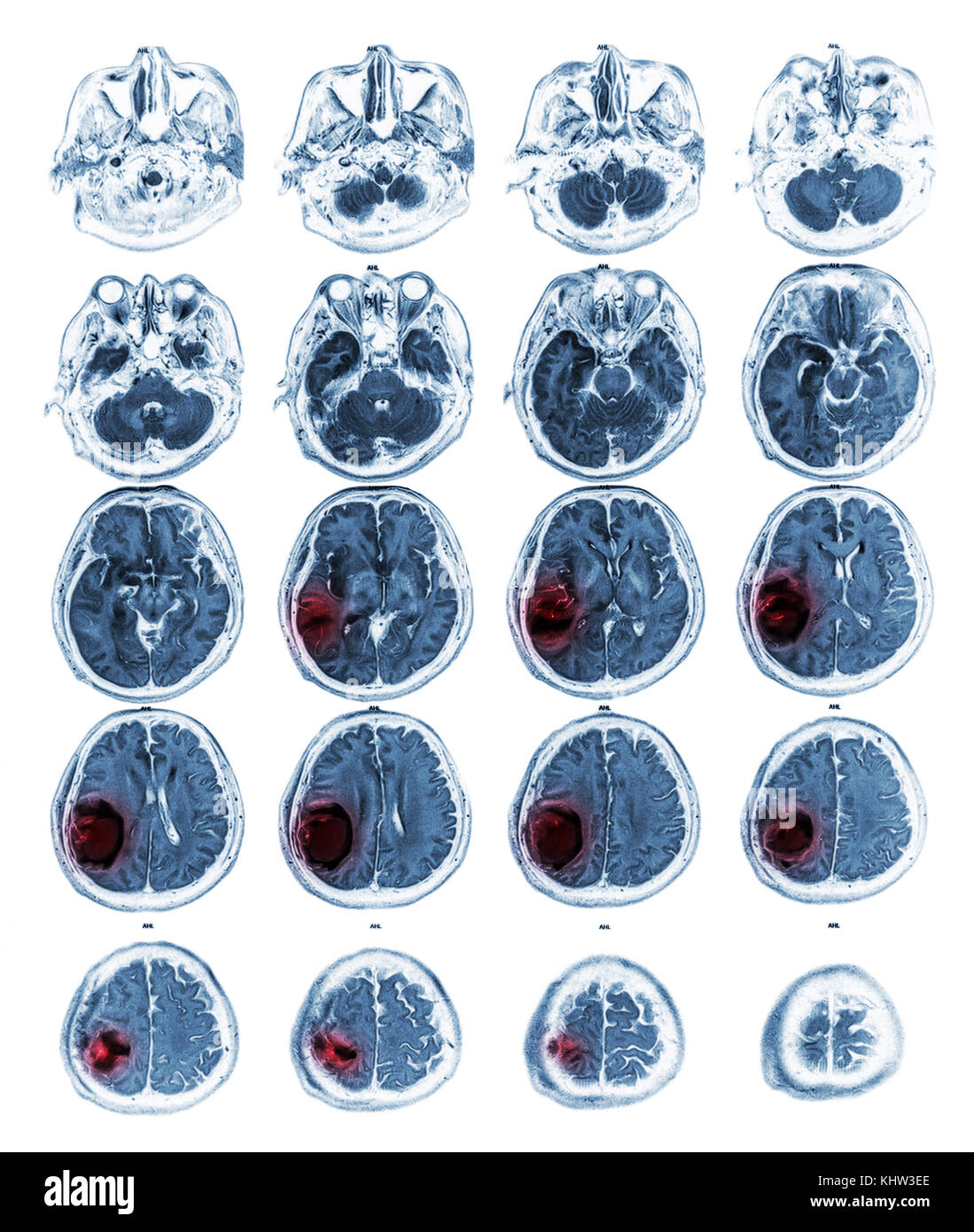 Voir irm de cerveau Tumeur au cerveau droit au lobe pariétal . Banque D'Images